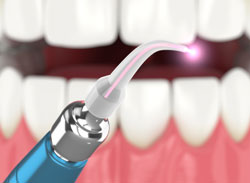 LASER THERAPY at Aesthetic Periodontal & Implant Specialists 