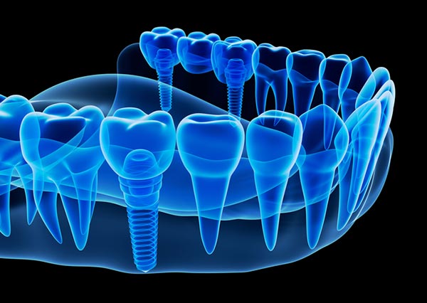 X-ray image of jawbone with dental implant in San Antonio