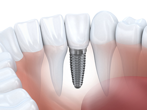 Illustration of dental implant used by Dr. Hosseini in San Antonio, TX 