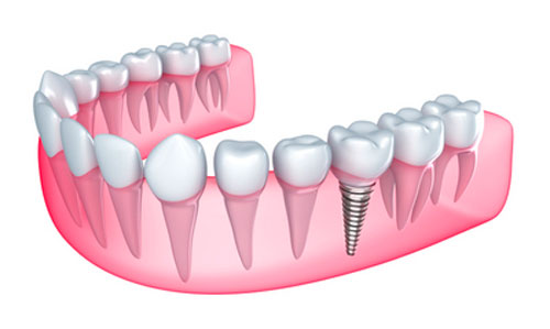 Illustration of dental implant used by Dr. Hosseini in San Antonio.