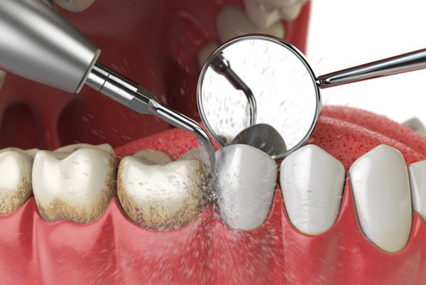 Diagram of teeth and gum cleaning.