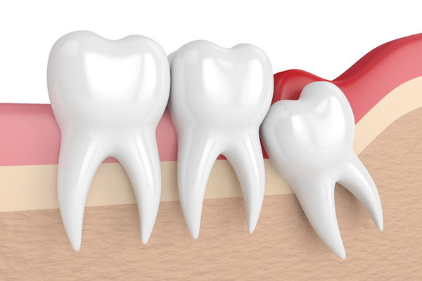 Impacted tooth at Aesthetic Periodontal & Implant Specialists