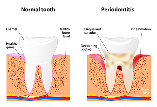 Diagram of healthy tooth compared to tooth with advanced gum disease by Dr. Hosseini in San Antonio, TX 