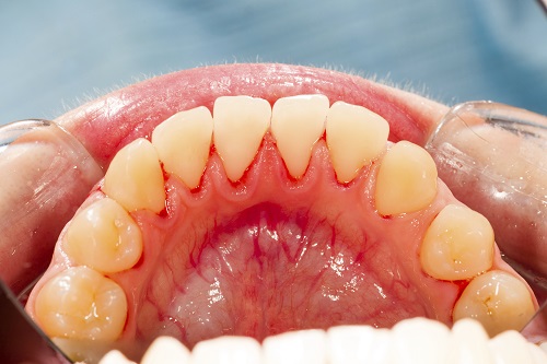 How a Gum Disease Diagnosis Goes