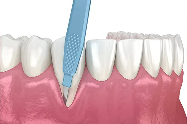 A gum grafting procedure where a dental tool is inserted in recessed part of gum, to address gum recession.
