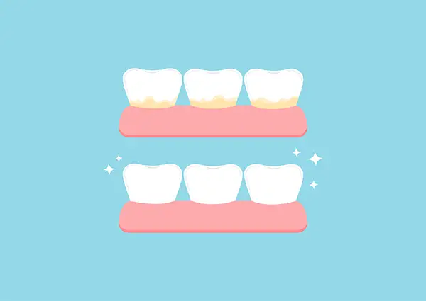 Illustration showing teeth before and after periodontal cleaning, highlighting the removal of plaque and tartar.