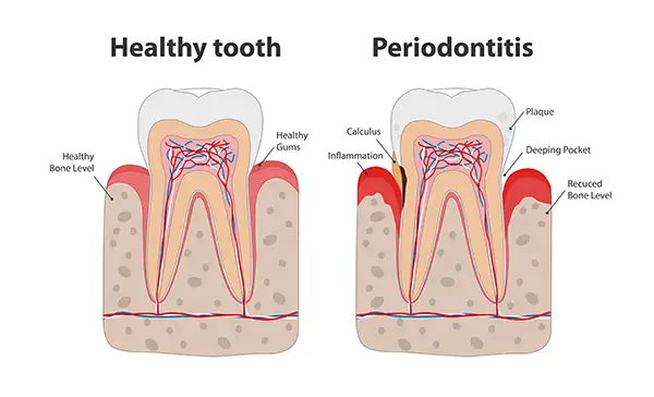 Diagram comparing a healthy tooth with one affected by periodontitis, showing gum inflammation and bone loss.