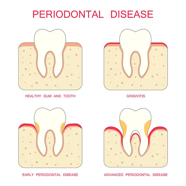 Diagram illustrating the progression of periodontal disease from healthy gums to advanced periodontal disease, highlighting symptoms like gingivitis and bone loss.