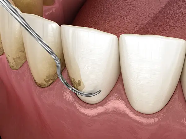 Close-up view of dental scaling and root planing to remove tartar buildup from the side of teeth.